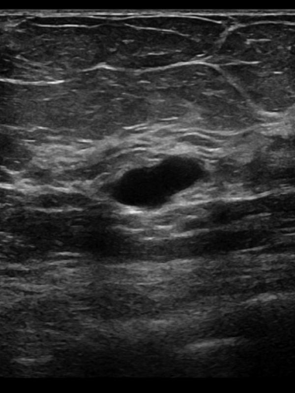 Breast image ultrasound