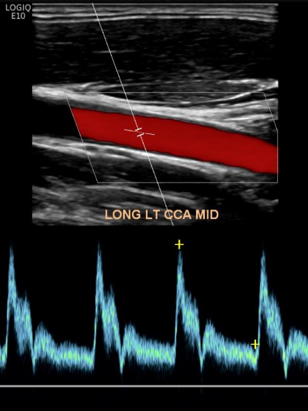 carotid ultrasound