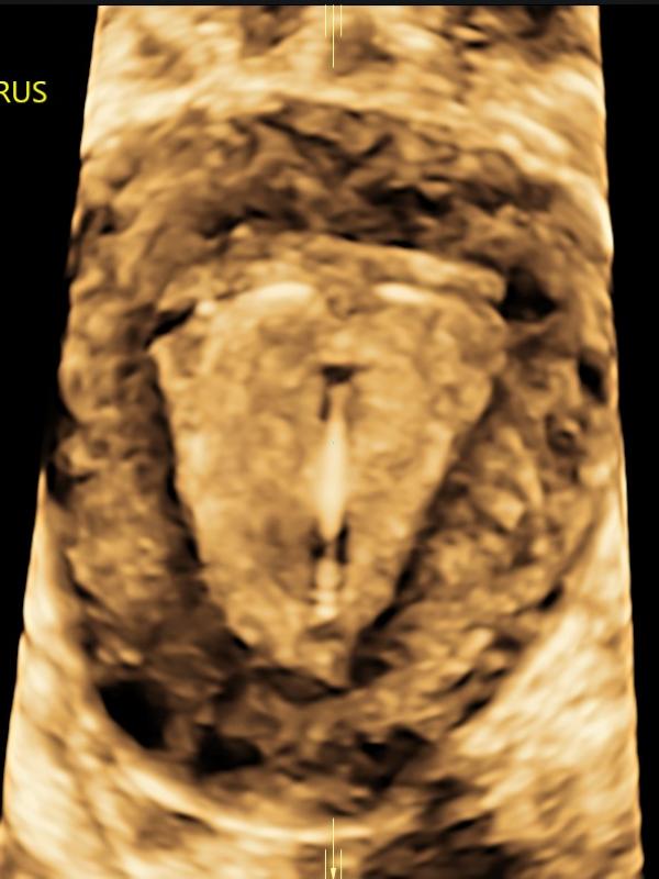 Female pelvic/gynecologic ultrasound 