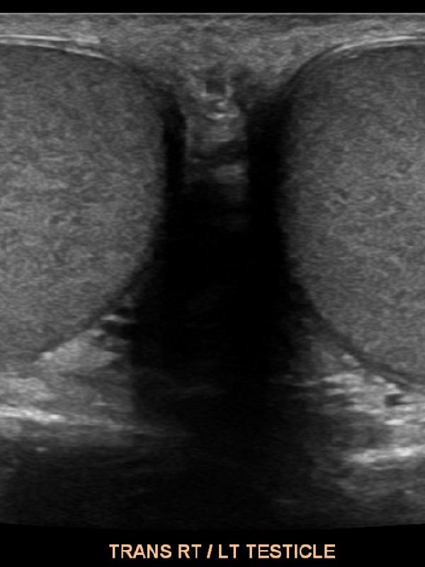 Scrotal ultrasound FAQ 