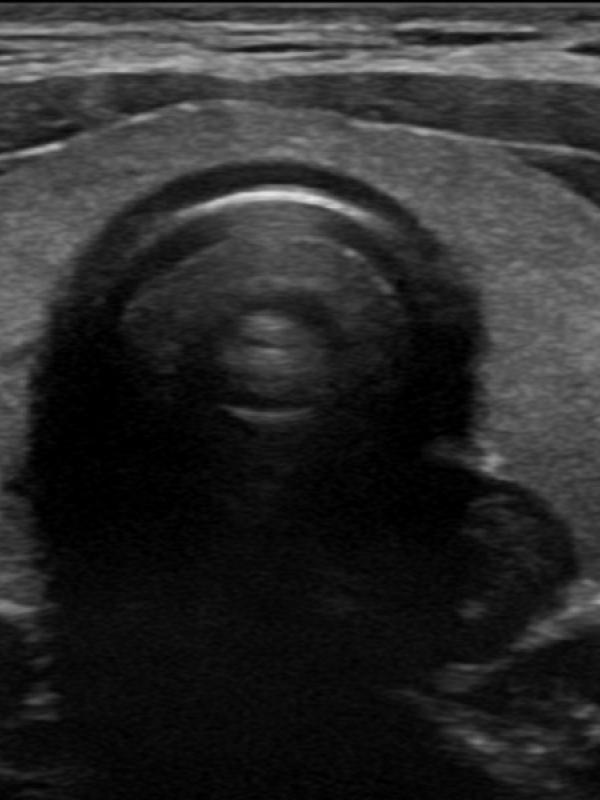 Thyroid ultrasound 