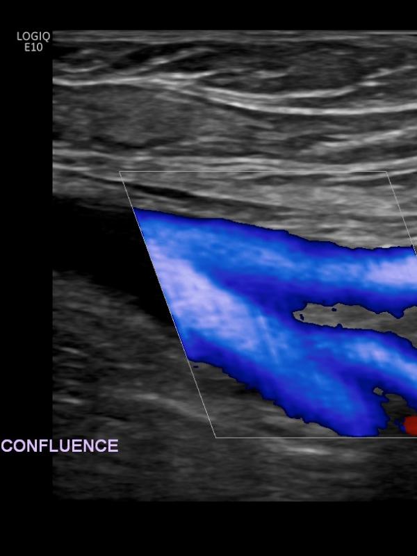 Venous ultrasound