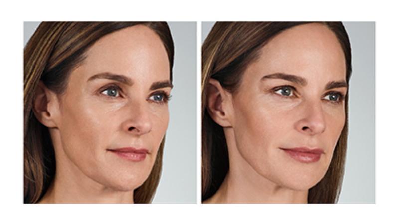 Volbella juvederm cropped woman