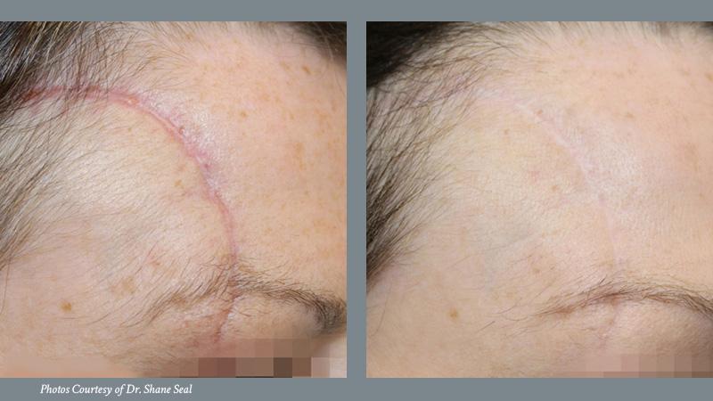 Scar Reduction Before and After