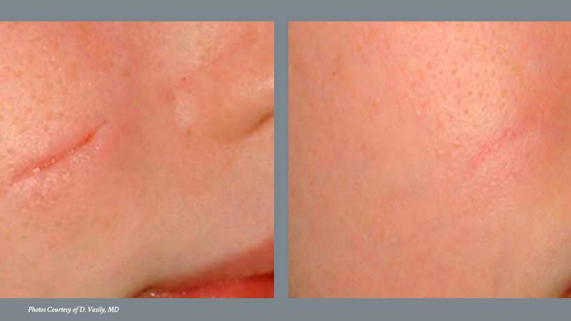 Scar Reduction Before and After 3