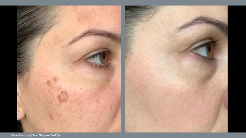 Skin Revitalization Before and After 3