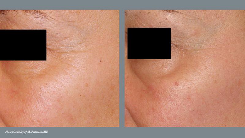 Skin Renewal Before and After 2