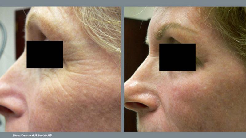 Skin Renewal Before and After