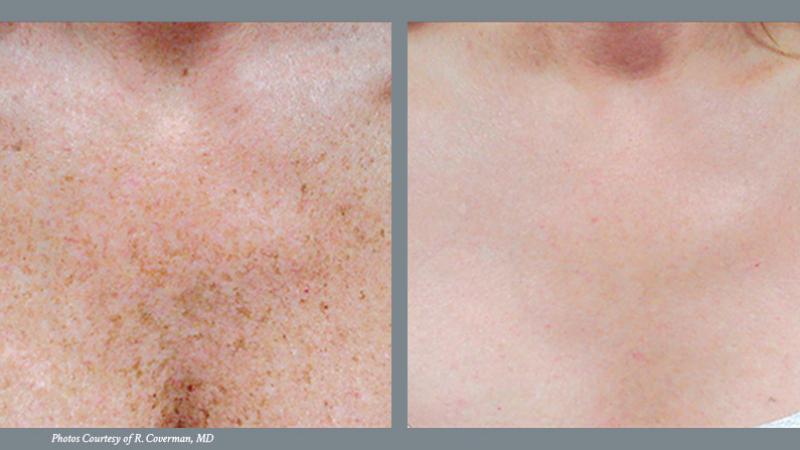 Skin Revitalization Before and After