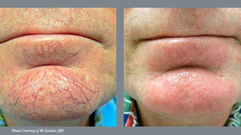 Skin Revitalization Before and After 1