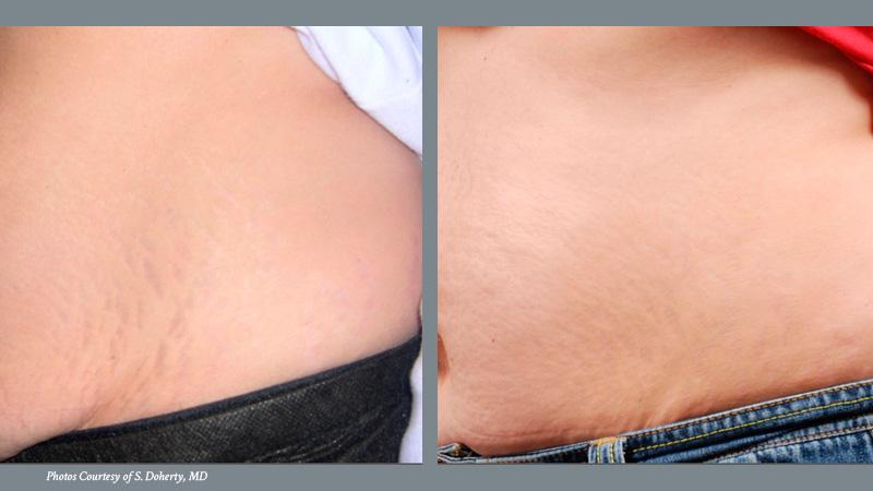 Stretch Mark Before and After 2