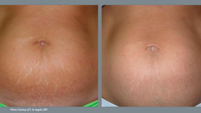 Stretch Mark Reduction Before and After